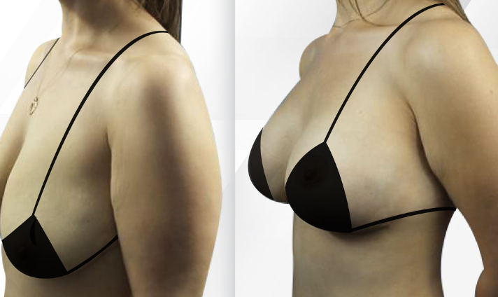 Get the best possible result after your surgery Breast augmentation Miami post thumbnail image