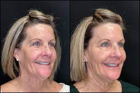 A Comprehensive Help guide to Botox Solutions in Roseville post thumbnail image